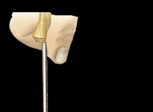 Servicing a mechanical fuel pump