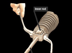 Replacing other types of track rod